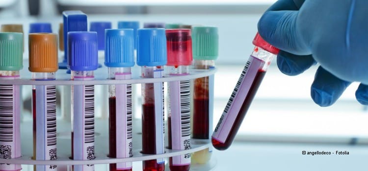 HIV-Test: Früher Bescheid wissen